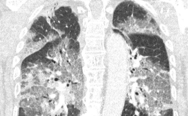 Imagen de archivo de los pulmones de un paciente con neumonía por covid. /HOY